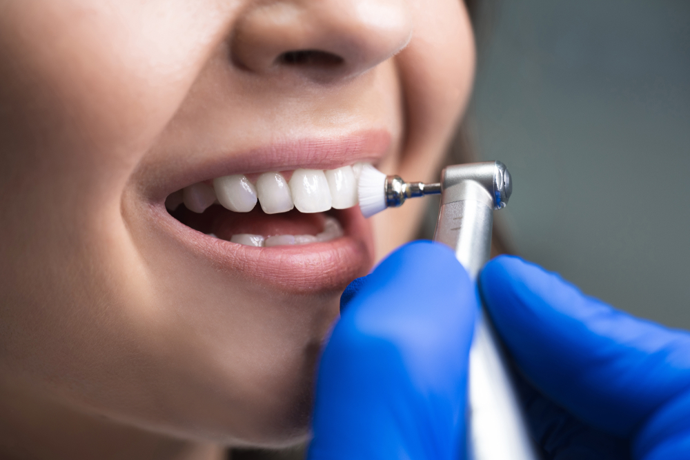 A close-up of a dental professional polishing a patient's teeth with a dental tool - Dentist University Place WA A close-up of a dental professional polishing a patient's teeth with a dental tool - Dentist University Place WA